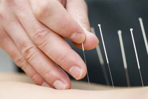 Les outils thérapeutiques de l'acupuncteur – Acupuncture du Nord